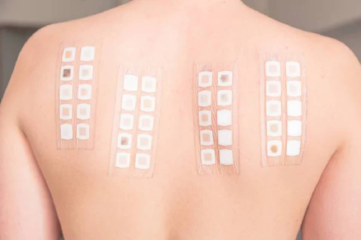 patch test