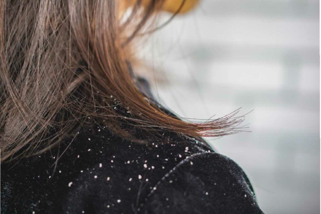 dandruff write for us