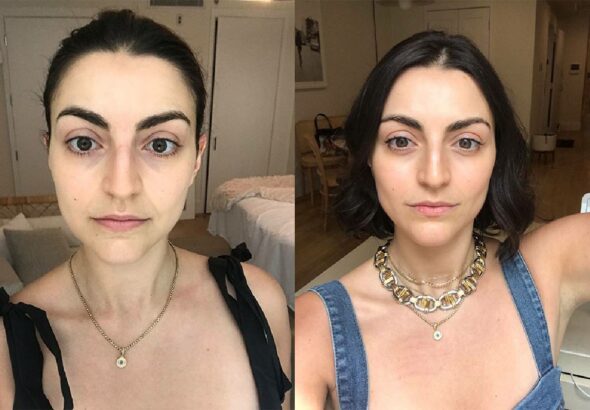 retinol before and after
